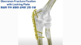 Locking Plate for Olecranon FracturesStability Redefined in Elbow Surgery 주관절 골절의 혁신잠금판을 통한 안정성 강화 [upl. by Princess]