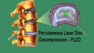 PLDD  Percutaneous Laser Disc Decompression [upl. by Argyle]