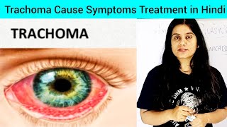 Trachoma Cause Symptoms Treatment Prevention in Hindi  What is Trachoma  Trachoma  Conjunctivitis [upl. by Oeniri]