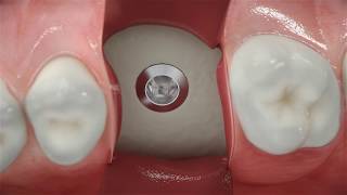 Straumann® BLX  Conventional posterior implant placement [upl. by Buckler]