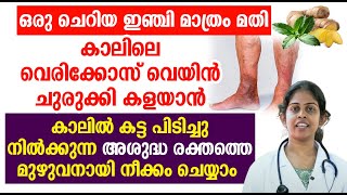 ഒരു ചെറിയ ഇഞ്ചി മാത്രം അതി കാലിലെ വെരിക്കോസ് വെയിൻ ചുരുക്കി കളയാൻ  Varicose veins Malayalam [upl. by Arlyn395]