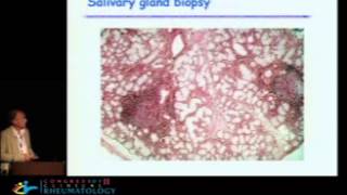 Update on Sjogrens syndrome from pathogeny to treatment  Xavier Mariette MD PhD [upl. by Nivaj]