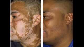 Vitiligo Before amp After Treatment [upl. by Eon216]