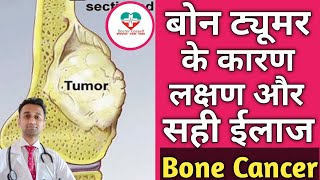 Bone Cancer बोन ट्यूमर के कारण लक्षण और सही ईलाज। DrKSChougule [upl. by Murphy]