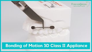 Forever Green  Bonding of Carriere® Motion 3D™ Class II Appliance [upl. by Modesta]