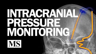 External Ventricular Drainage and Intracranial Pressure Monitoring [upl. by Acacia]