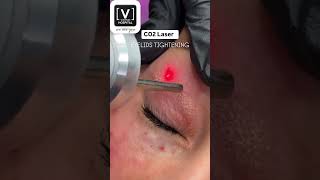 Co2 Laser Treatment  Eyelids Treatment  Best Derma Hospital in Kanpur [upl. by Niccolo18]