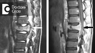 Can disc regenerate after Spinal Tuberculosis  Dr Mohan M R [upl. by Jock263]