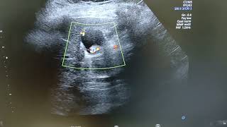 Adenomyomatosis  Comet tail artifacts  Choleithiasis [upl. by Sucram]