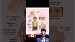 Erbs palsy nerve injury one hand weakness paralysis shorts [upl. by Zeuqram]