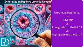 Differentiating Papillary Urothelial Neoplasms [upl. by Eicnarf701]