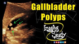 Gallbladder Polyps  Ultrasound  Case 136 [upl. by Heiney]