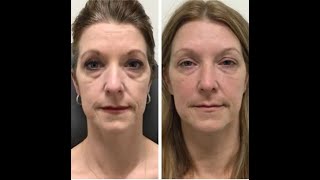 Under Eye Filler Before  After  Nashville Injector [upl. by Ahtamat]