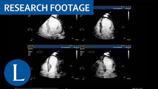 Dobutamine stress echocardiography to diagnose coronary artery disease [upl. by Herbst221]