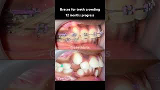 Crooked teeth Braces in 12 months progress braces orthodontics dental dentist teethbits [upl. by Dasi701]