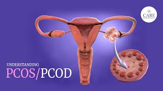 PCOSPCOD Symptoms Causes and Treatment  Menstruation Cycle [upl. by Anstice]