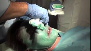 ZO Dr Obagi Controlled Depth Peel Blue Peel 1 [upl. by Harmonia570]