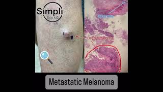 Metastatic Melanoma [upl. by Okramed]