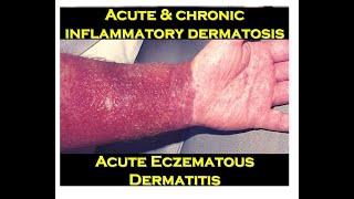 3b  Acute Eczematous Dermatitis [upl. by Dorelia]