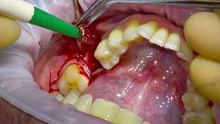 Removing an Unhealthy Dental Implant [upl. by Elraet733]