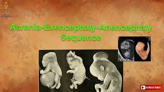 AcraniaExencephalyAnencephaly Sequence [upl. by Mariya]