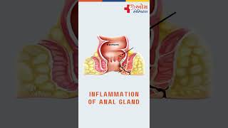 Factors that can lead to the development of Fistula in Ano [upl. by Dirraj]