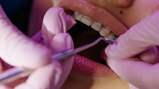 Gingivitis Treatment How Much Will it Cost Discover Affordable Options Now [upl. by Ttenaej381]