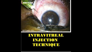 Procedure of Scleral Intravitreal Injection technique video [upl. by Haibot]