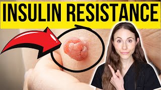 6 Warning Signs Of Insulin Resistance NOT TO MISS [upl. by Aicener]