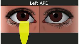 Relative Afferent Pupillary Defect  Medical Student Education [upl. by Grannia]