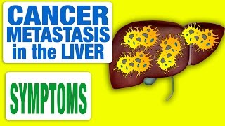 Cancer Metastasis in the Liver  All Symptoms [upl. by Trager]