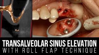 Transalveolar Sinus Elevation and Roll Flap Technique [upl. by Hobie]