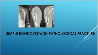 Simple bone cyst with pathological bone fracture [upl. by Lered]