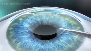 Carl Zeiss Meditec  Visumax  RELEX SMILE [upl. by Lohse]