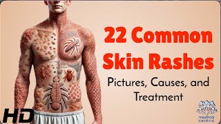 22 Skin Rashes Everyone Should Know About Symptoms amp Treatments [upl. by Nibram57]