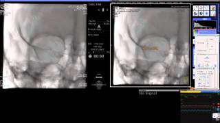 Ystentassisted coil embolization of cerebral aneurysms [upl. by Neau]