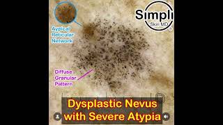 Severely Dysplastic Nevus Dermoscopy [upl. by Anitsirc]