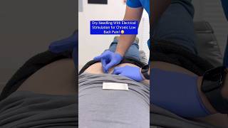 Relieving chronic low back pain through dry needling with electrical stimulation shorts [upl. by Roxanne]