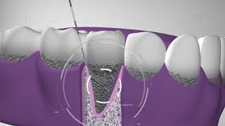 Curetaje higiene dental Te explicamos el procedimiento en Dentix [upl. by Aivat]