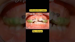 Orthodontics power Braces on crowding teeth [upl. by Ronaele]