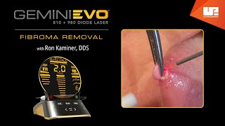 Fibroma Removal  Gemini EVO™ clinical cases [upl. by Elamaj]