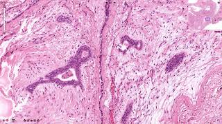 Fibroadenoma  Histopathology [upl. by Wickham]