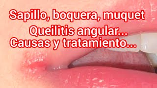 Sapillo boquera muquet queilitis angular y sus posibles causas [upl. by Ttoille641]