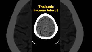 Thalamic Lacunar Infarct  Thalamic stroke  CT Brain 🧠stroke brain ctscan [upl. by Bree485]