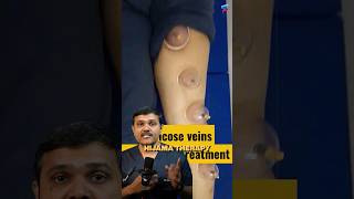 Shocking Truth about Cupping HIJAMA Therapy for Varicose Veins veindoctor [upl. by Moffit410]