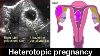 Heterotopic Pregnancy Diagnosis on Ultrasound Made EASY [upl. by Ayidah902]