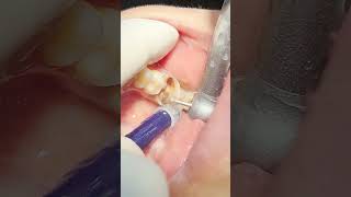 Deep tooth caries That tooth will be goner pt2dentist health teethcleaning 🦷beadrepair [upl. by Alwyn]