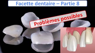 Facette dentaire  Problèmes possibles  Guide complet  partie 8 [upl. by Trilbi382]