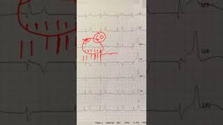 Tall Peaked T Waves  Cardiology for Medical Students [upl. by Ahseuqram]