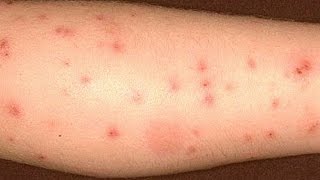 How to get rid of bed bug bites [upl. by Dael]